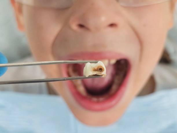Best Emergency Root Canal Treatment in Washington Park, IL